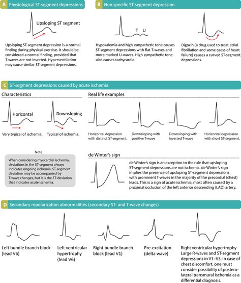68 causes of T wave, ST segment abnormalities .